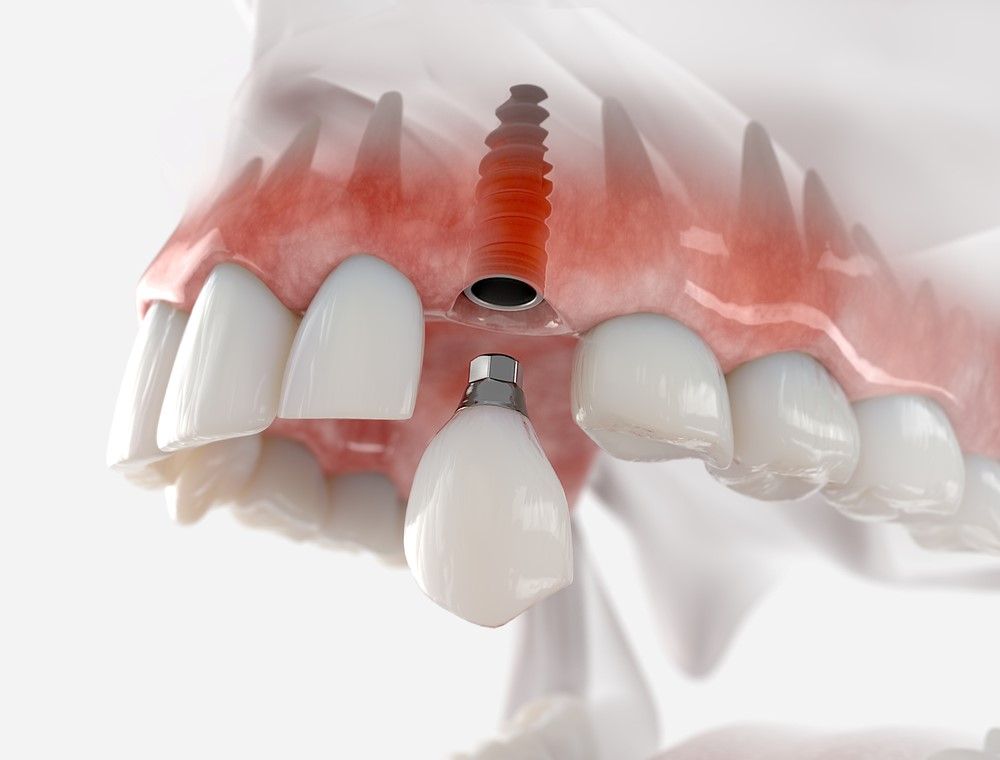Dental implant doctor in downtown Toronto
