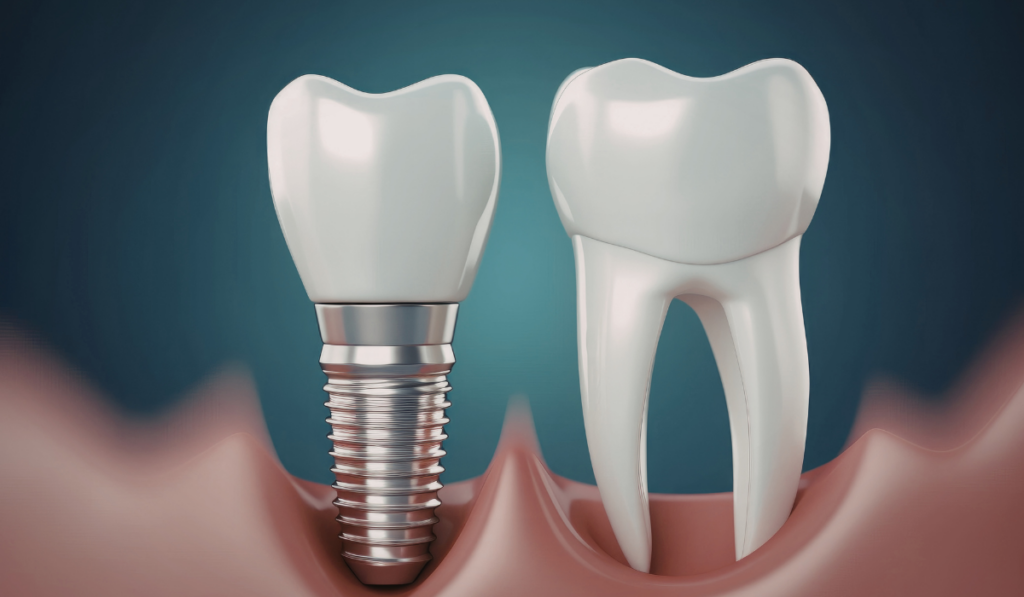 dental implants restoration at City Dental on Bay Toronto